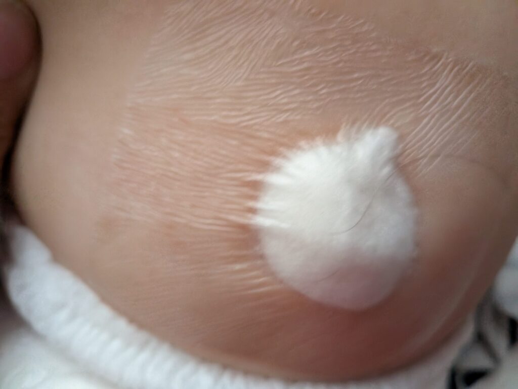 出べそ